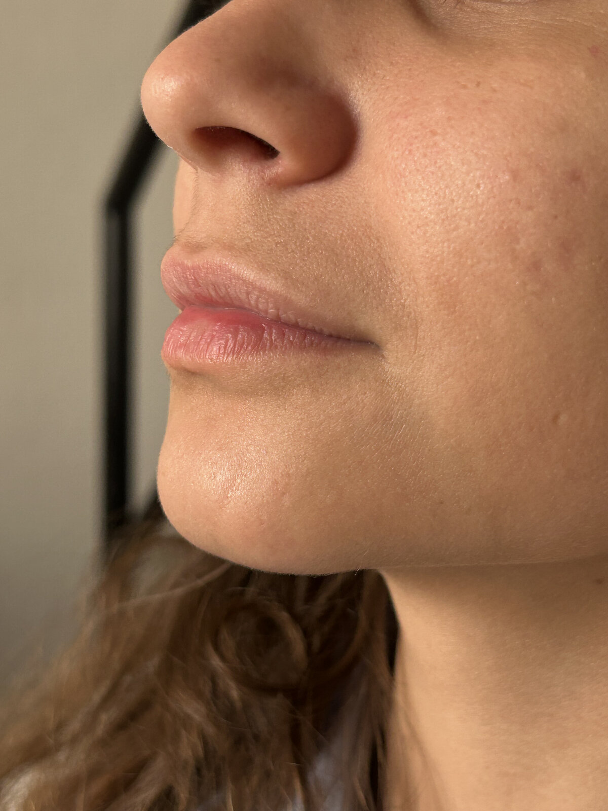 Antes botox Belo Horizonte — Dra. Emily Beatriz