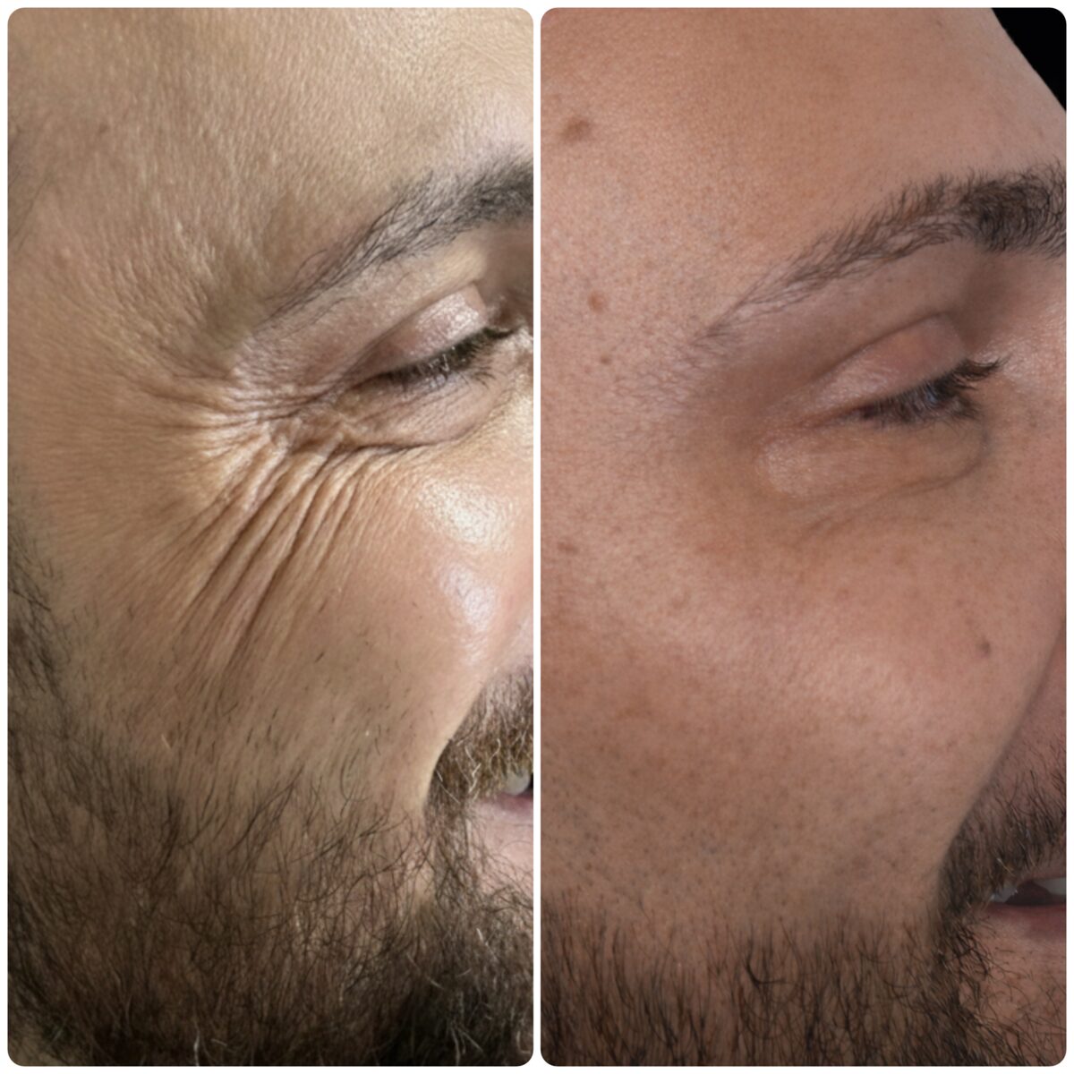 Antes e depois harmonização facial Belo Horizonte — Dra. Emily Beatriz