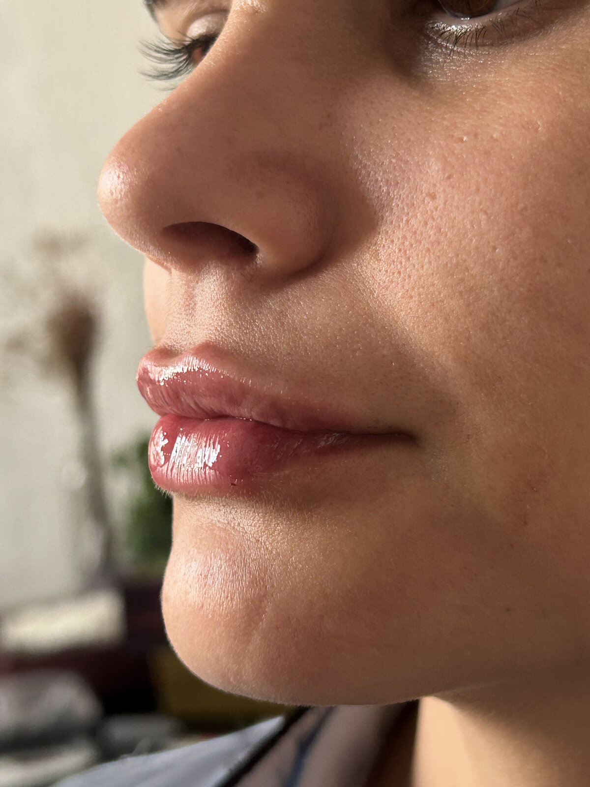 Depois botox BH — resultado natural Dra. Emily Beatriz